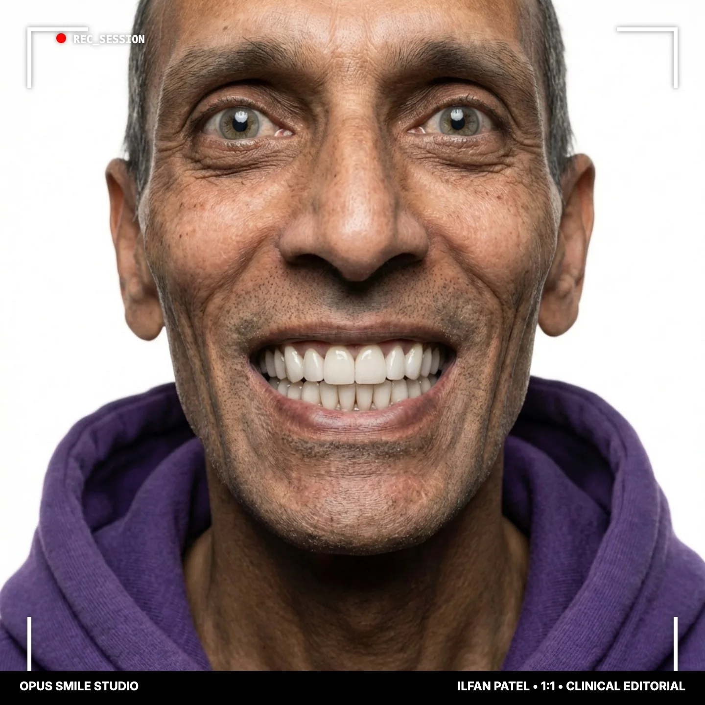 Ilfan Patel after All-on-6, both jaws