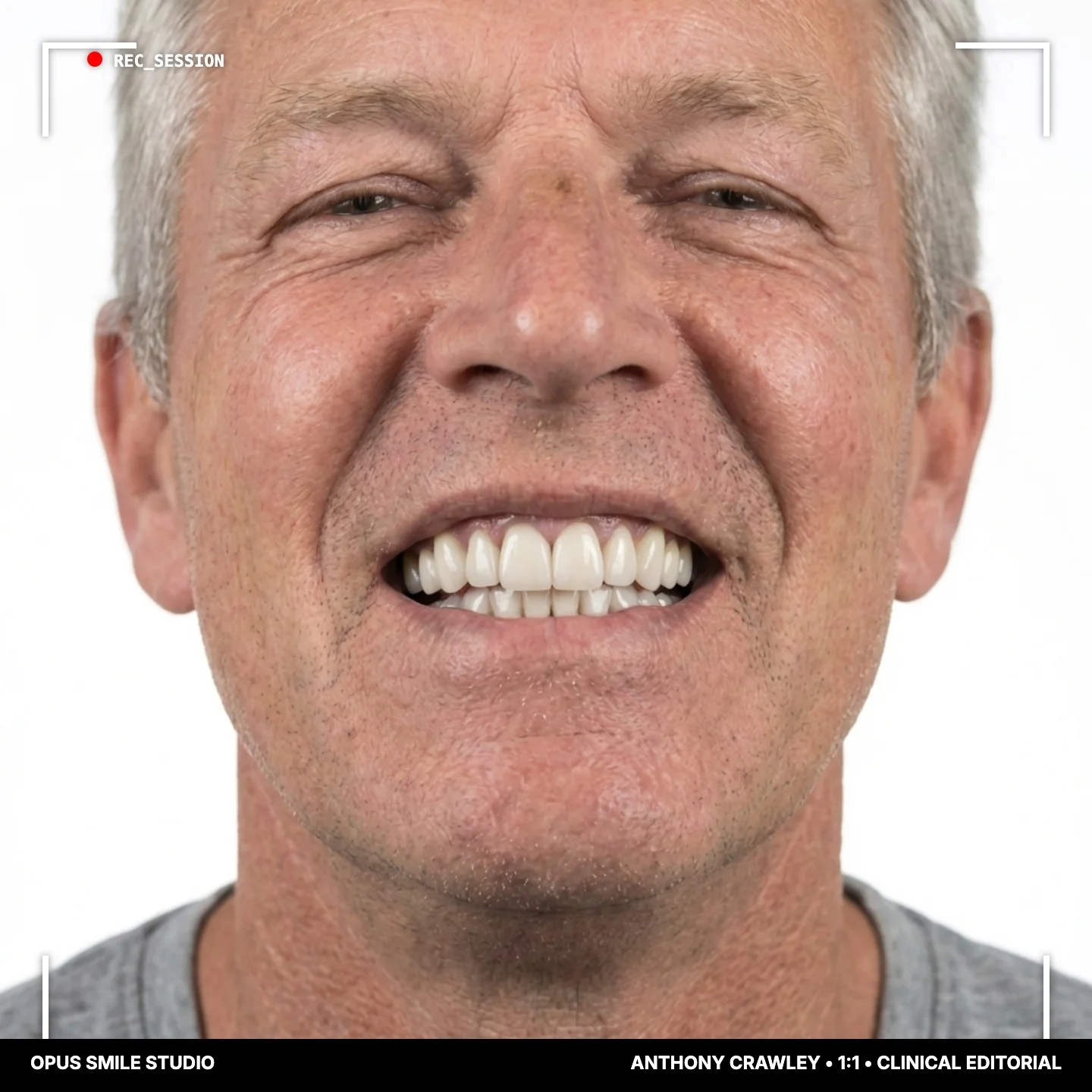 Anthony after Full smile rebuild, fixed teeth