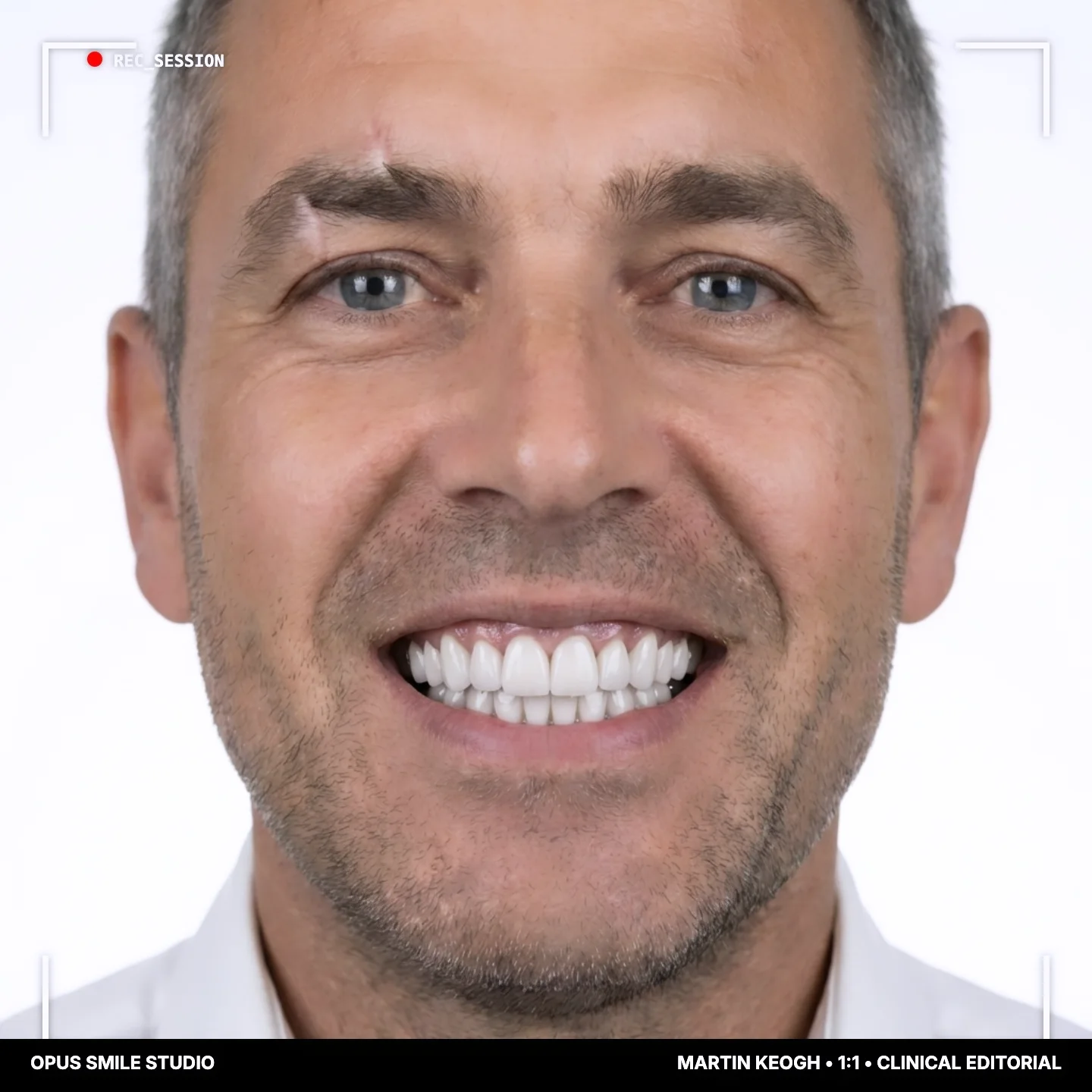 Martin after Fixed full-arch implants