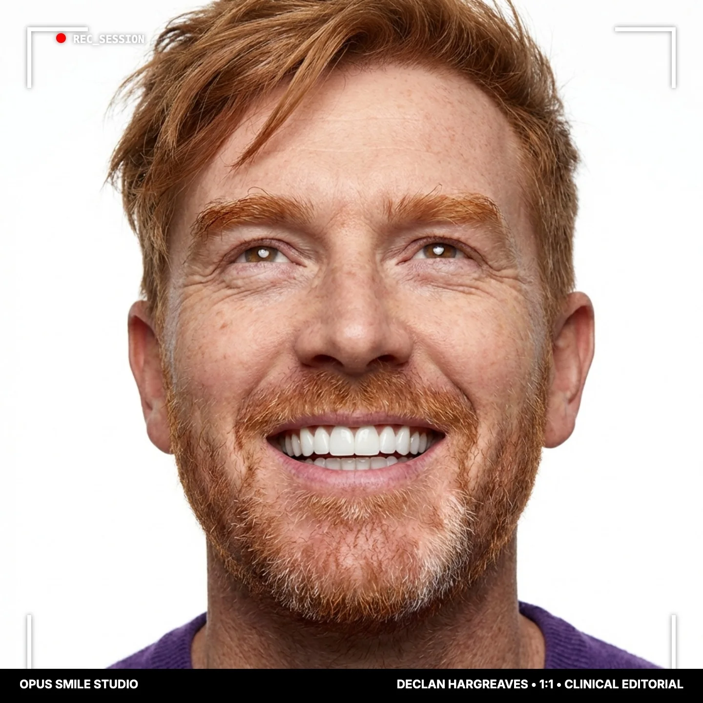 Declan after Full smile restoration