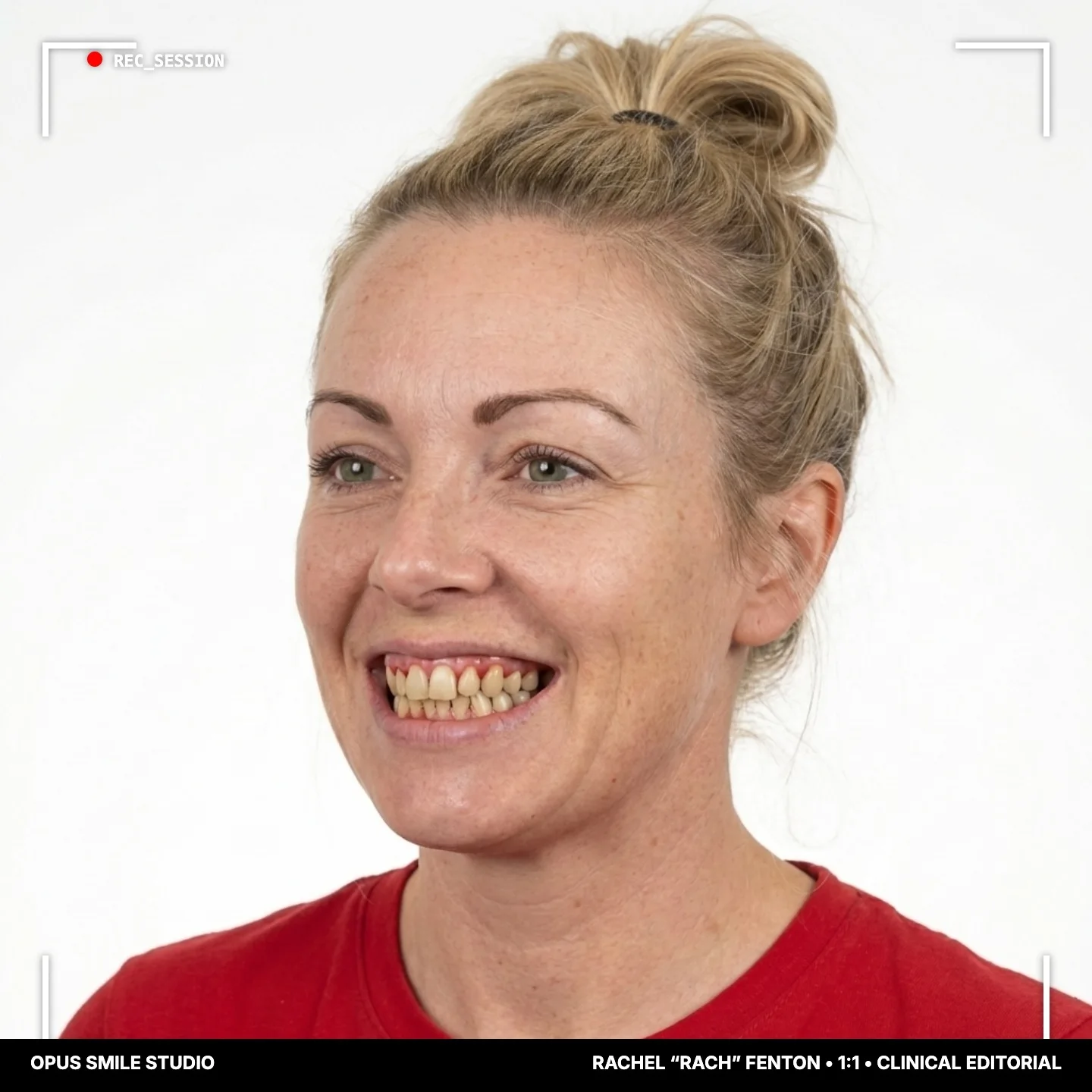 Rach before treatment