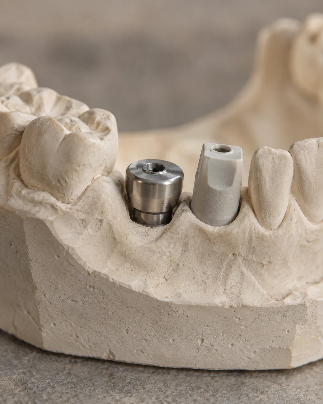 A titanium healing cap and a scan body seated on implants in a plaster model