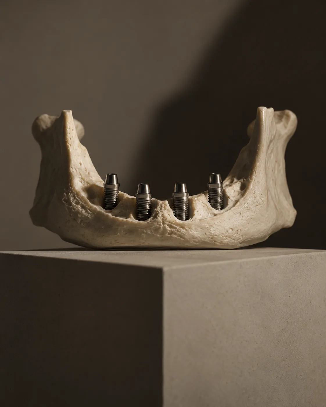 A lower jaw model on a plinth with four titanium fixtures set into the bone