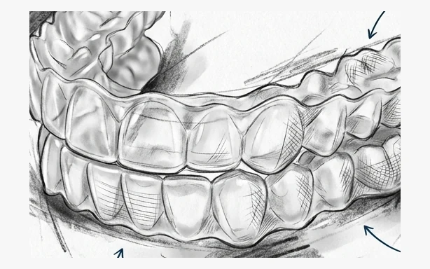 Pencil study of a clear thermoplastic aligner seated over the upper and lower arches