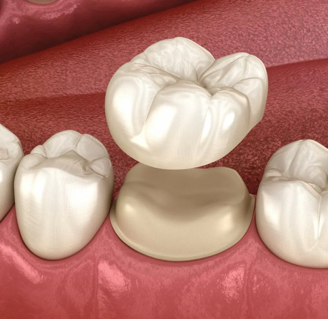 Dental Crown Cost Turkey vs UK: 2026 Price Comparison