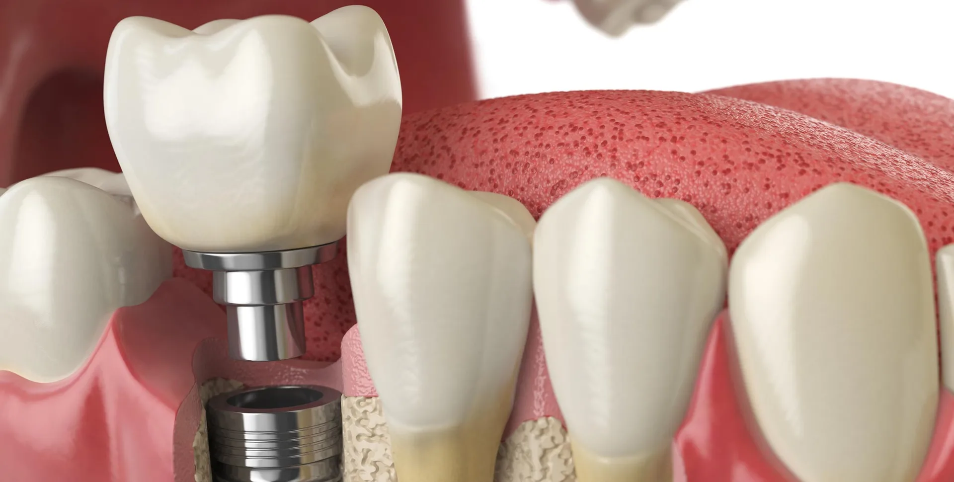 Snap-On Smile Turkey: Costs, Pros, Cons and Who It Suits Best