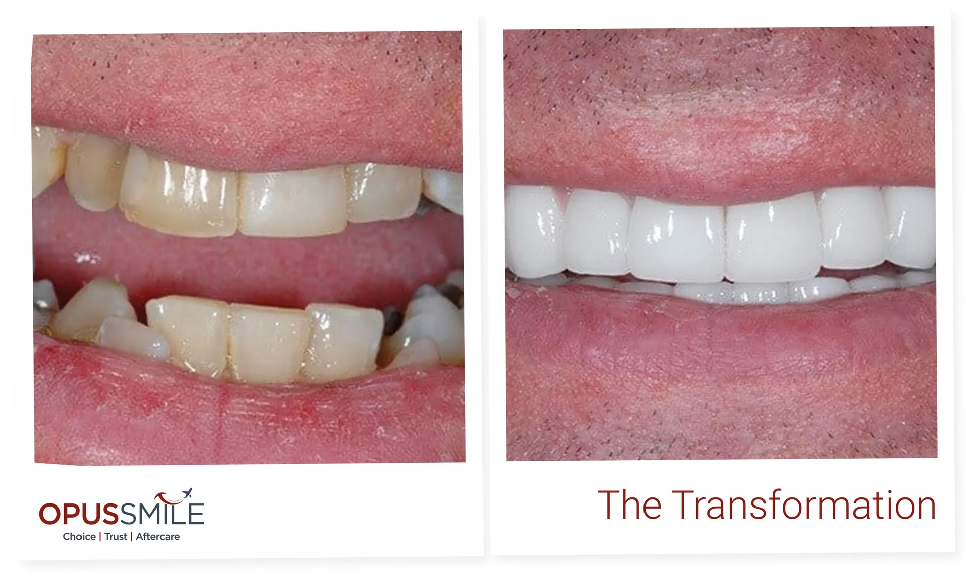 Zirconia Crowns in Turkey: Cost, Benefits and How They Compare to Other Materials