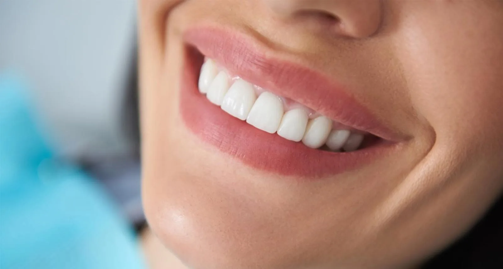 Dental Bonding in Turkey: Affordable Solutions for a Perfect Smile