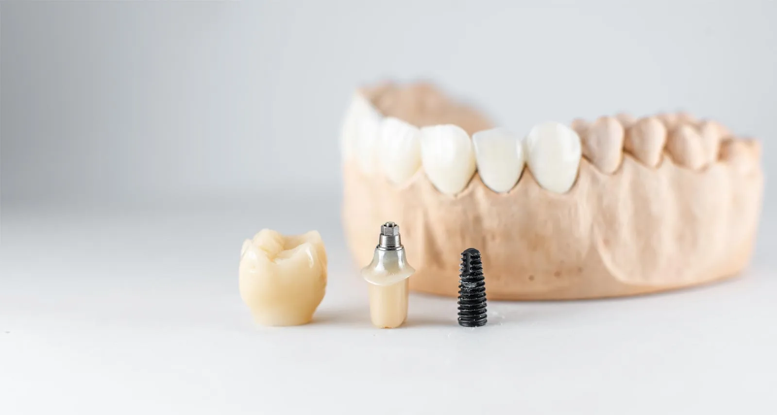 The Risks of Dental Implants Abroad: What to Consider