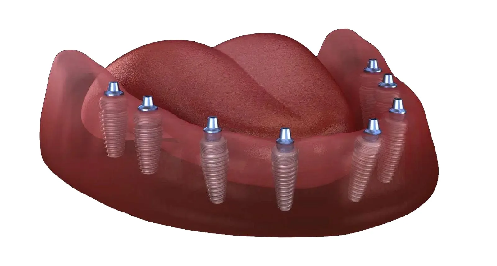 All-on-8 Dental Implants in Antalya, Turkey: Your Path to a Full Smile