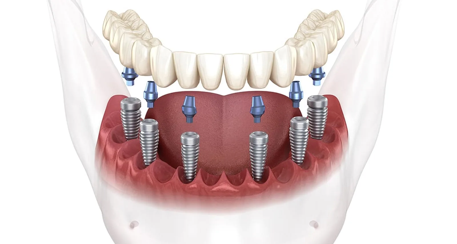 Dental Implant Abroad: Check Prices & Reviews in Europe