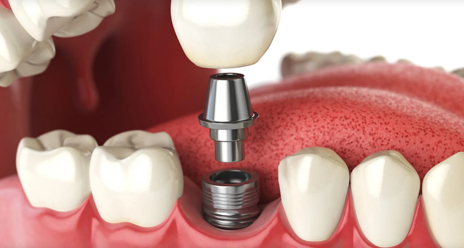 Dental Implants in Istanbul, Turkey: Your Guide to Top Clinics and Care