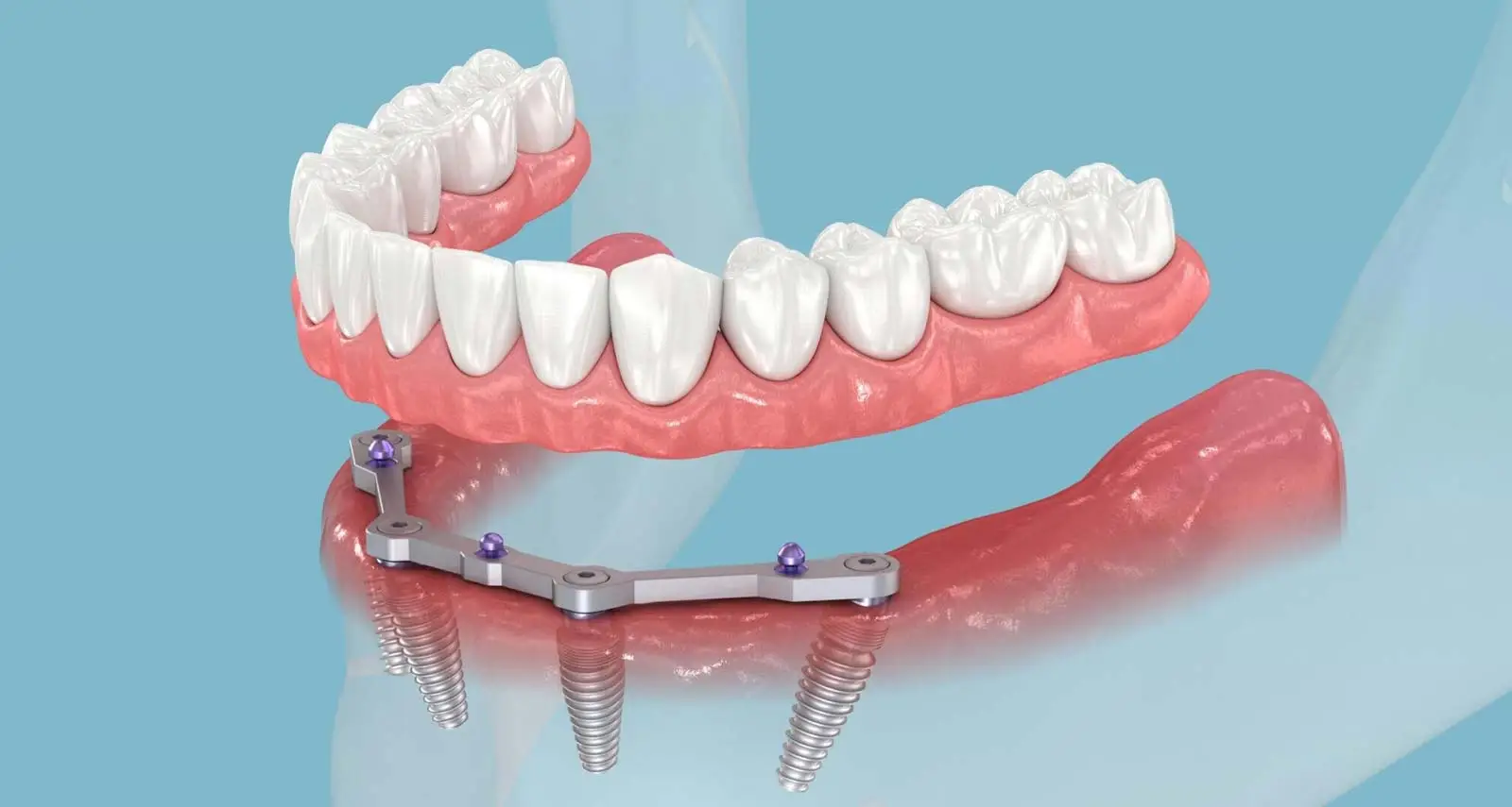 All-On-4 Dental Implants: A Comprehensive Guide to Pricing