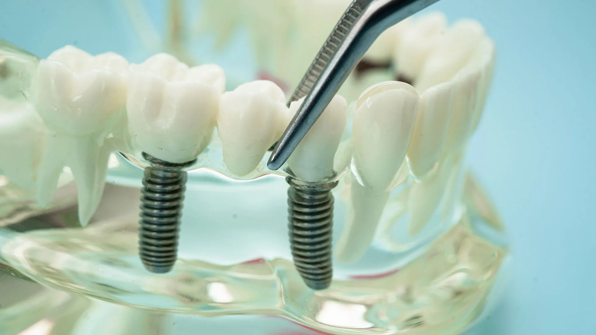 Dental Bridges vs Implants: Which Is the Right Choice for You?