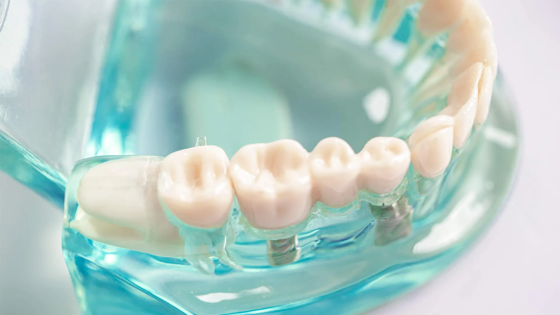 Dental Implant Aftercare: The Complete Recovery Guide for 2026