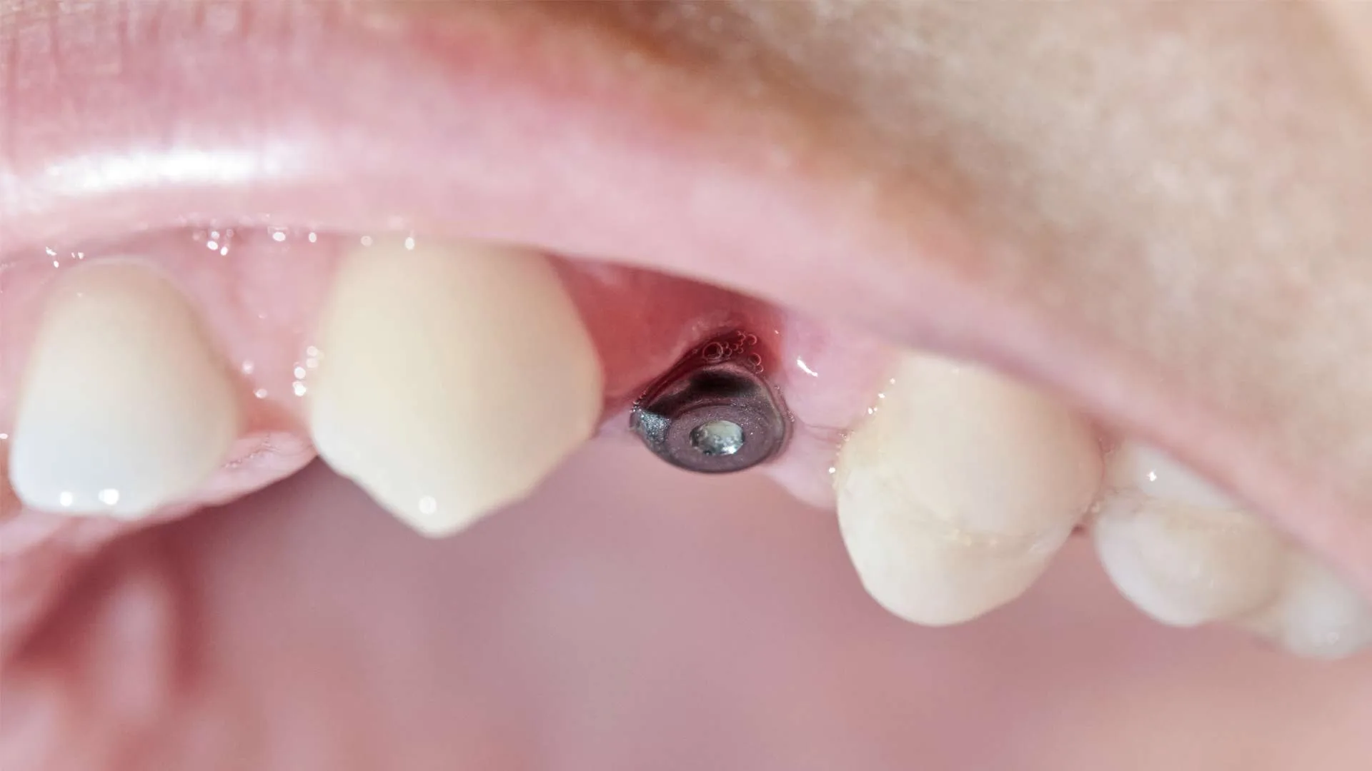 Dental Implant Problems Years Later: What Can Go Wrong and How to Prevent It