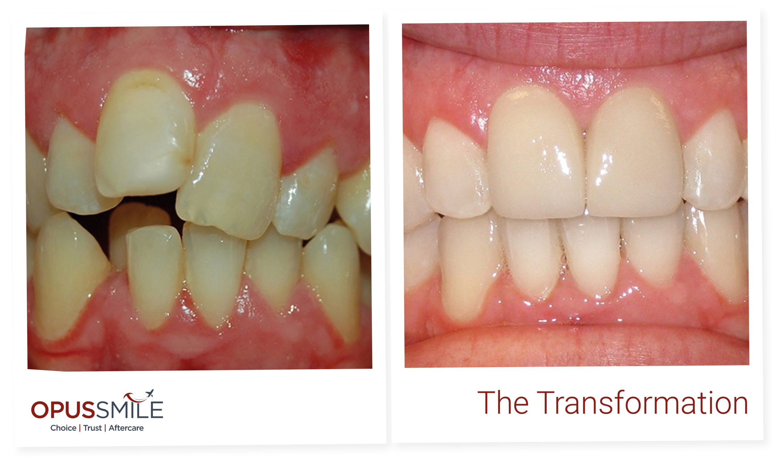 Aligners 1