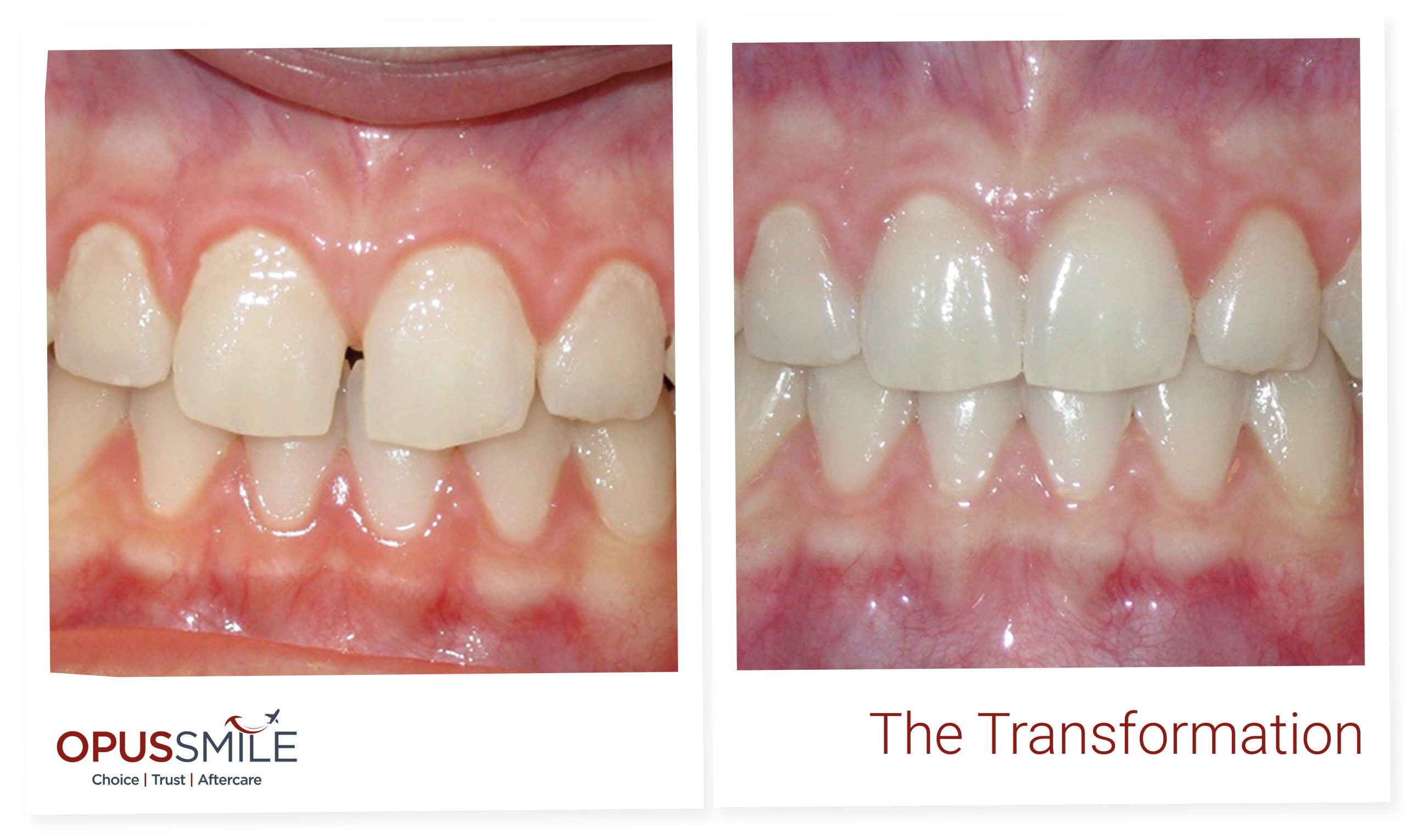 Aligners 2