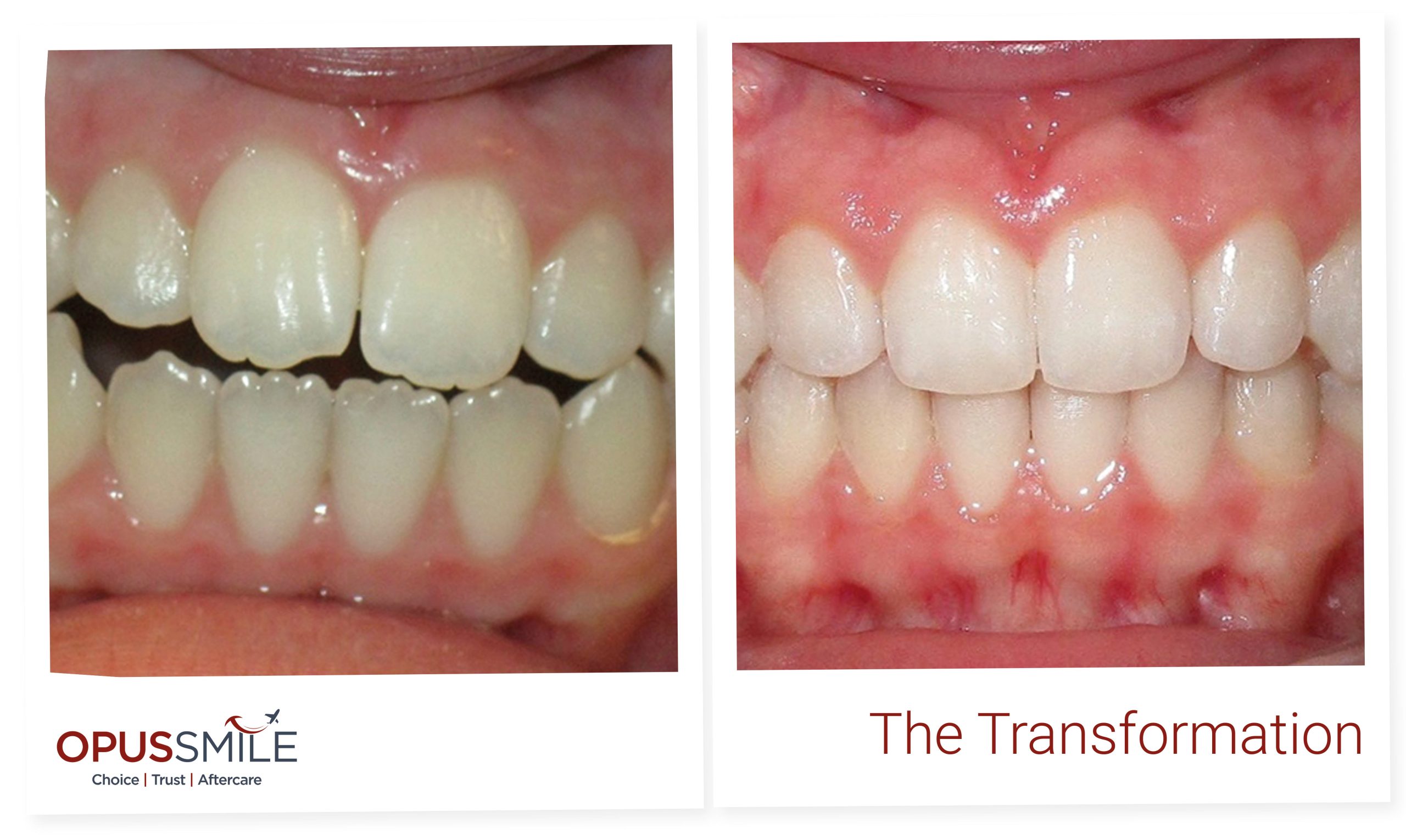 Aligners 3