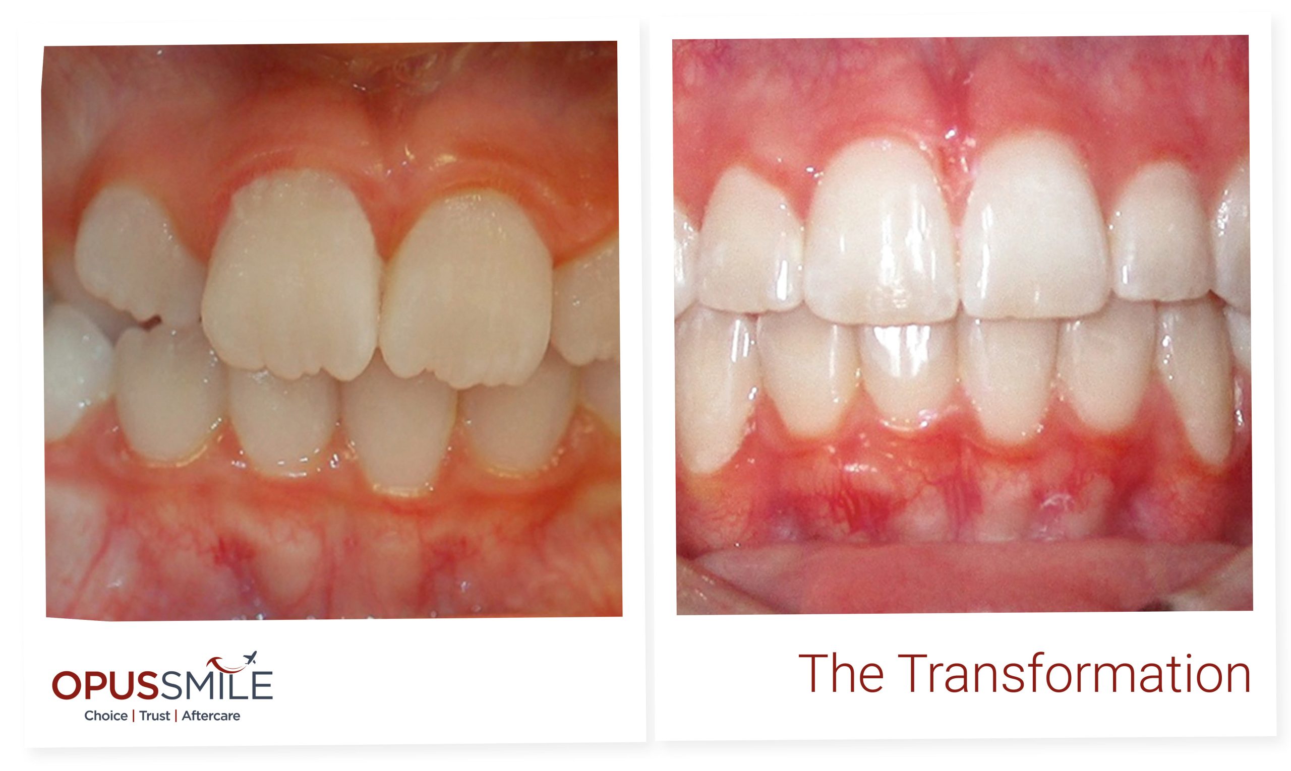 Aligners 4