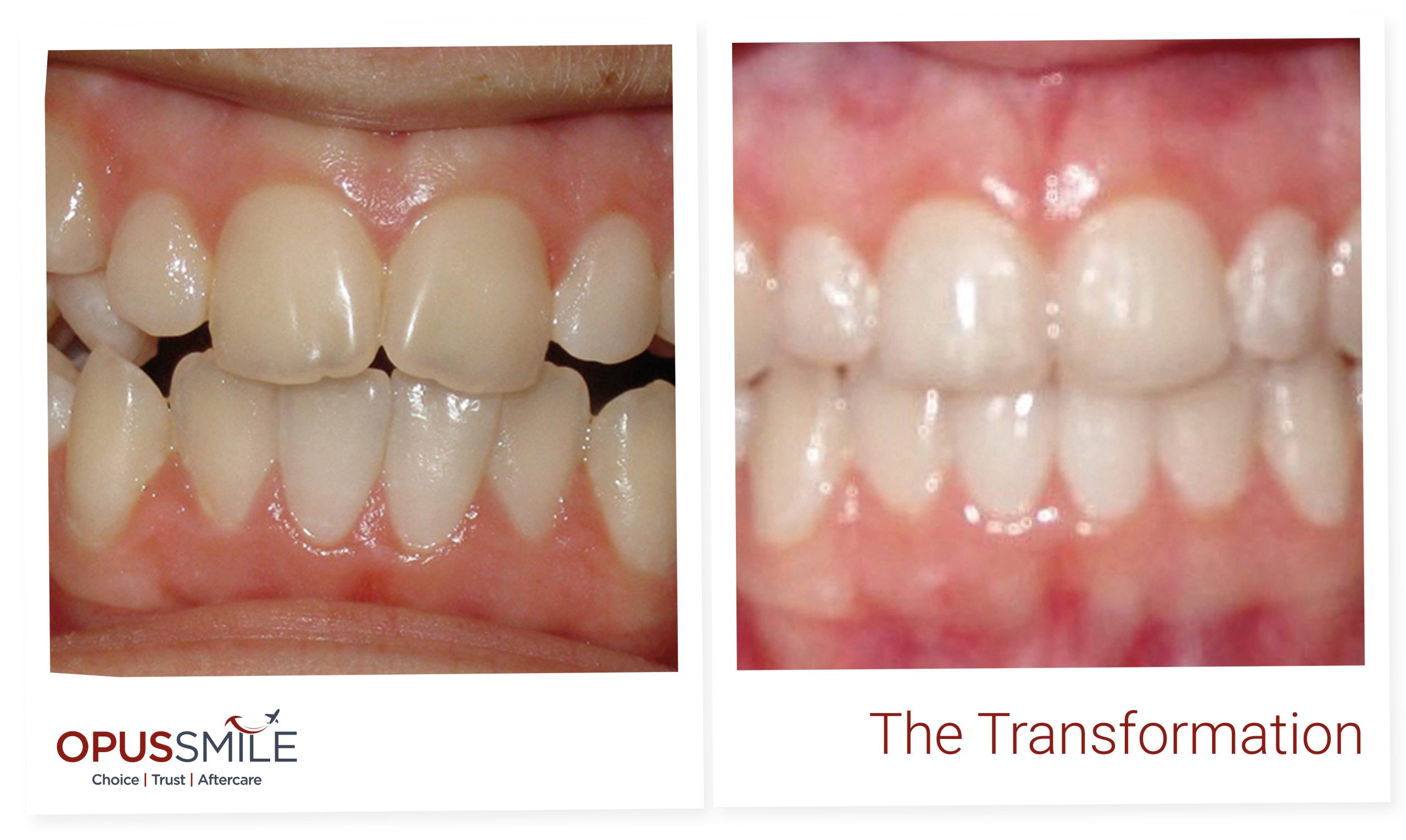 Aligners 5