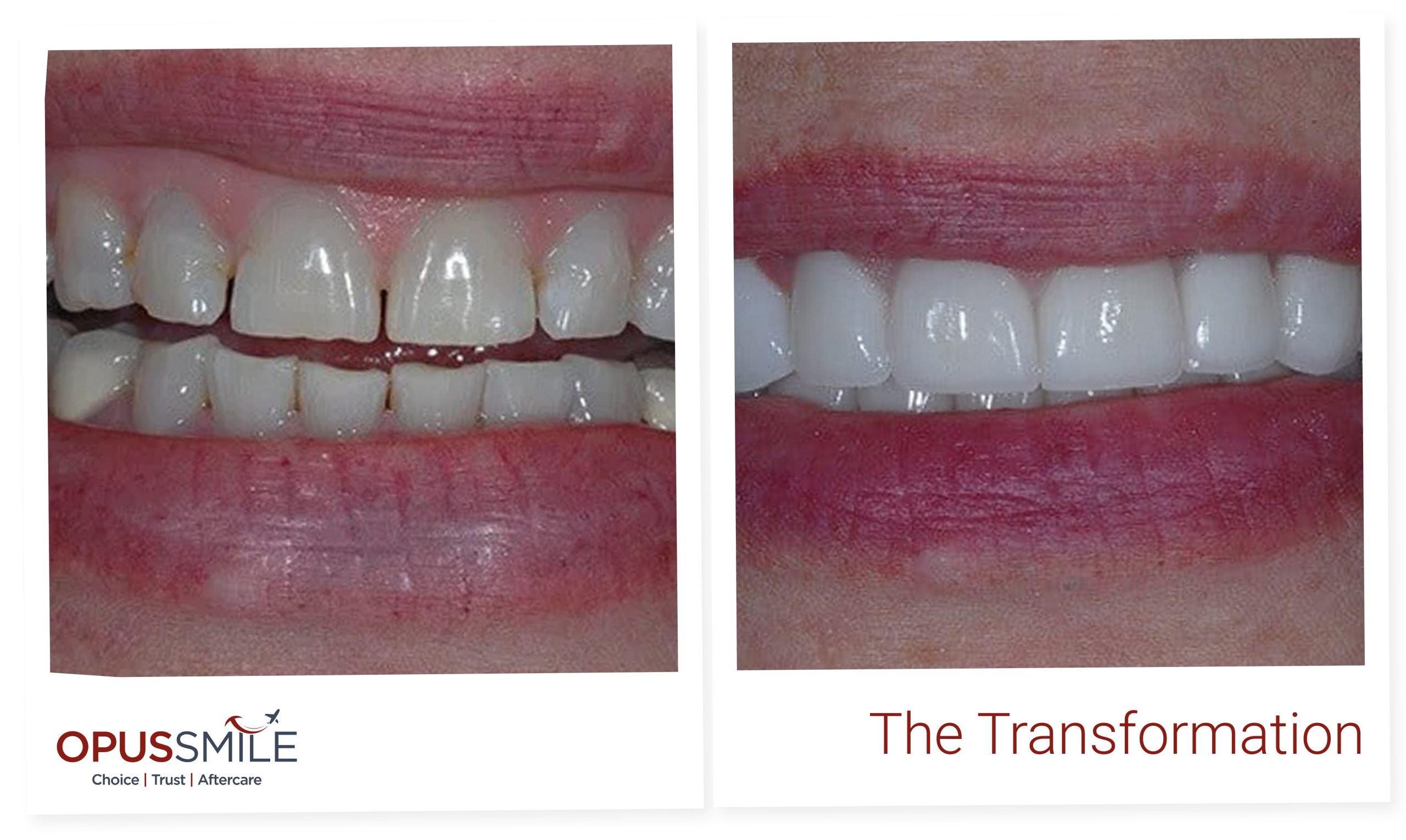 Smile Makeover 1