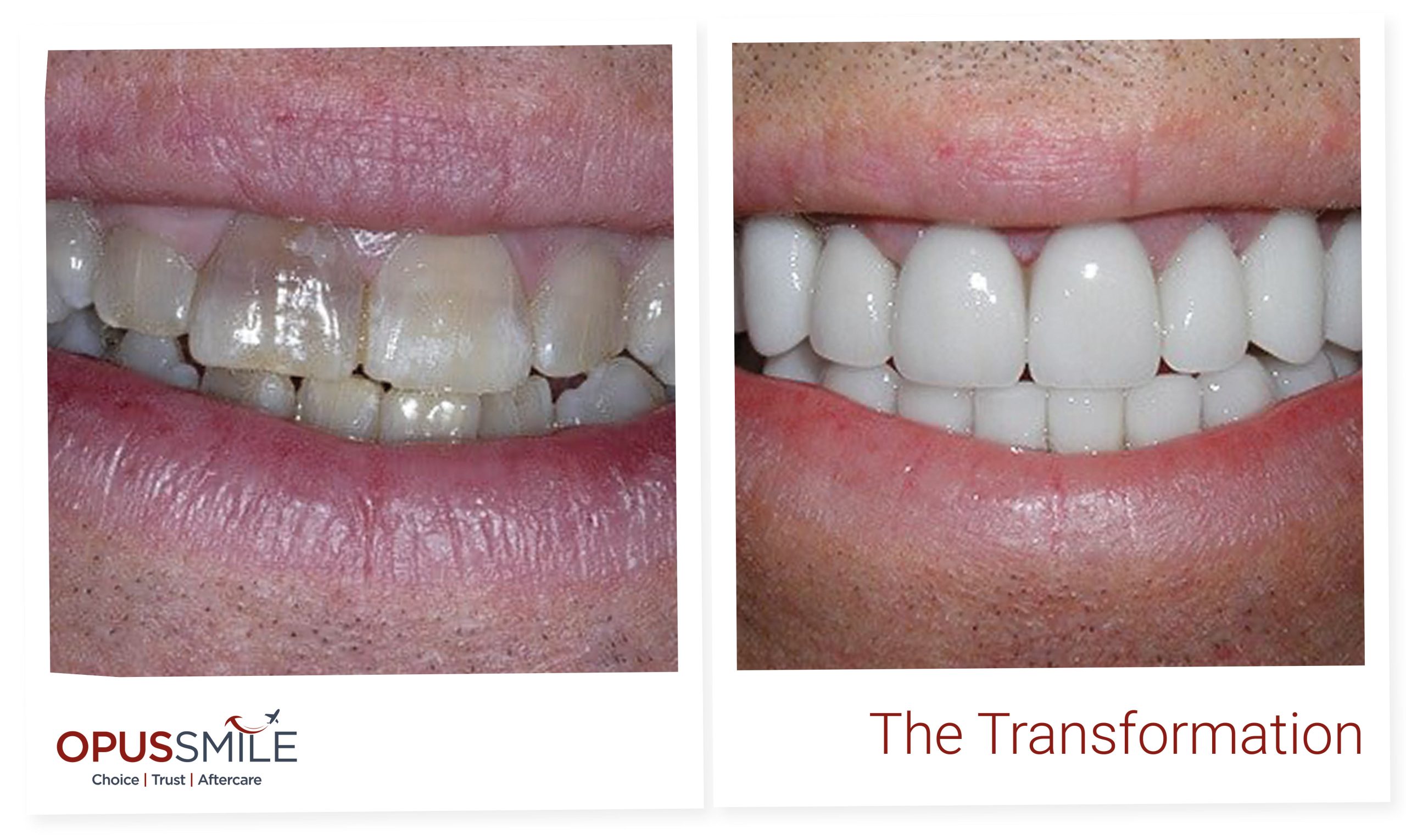 Smile Makeover 2
