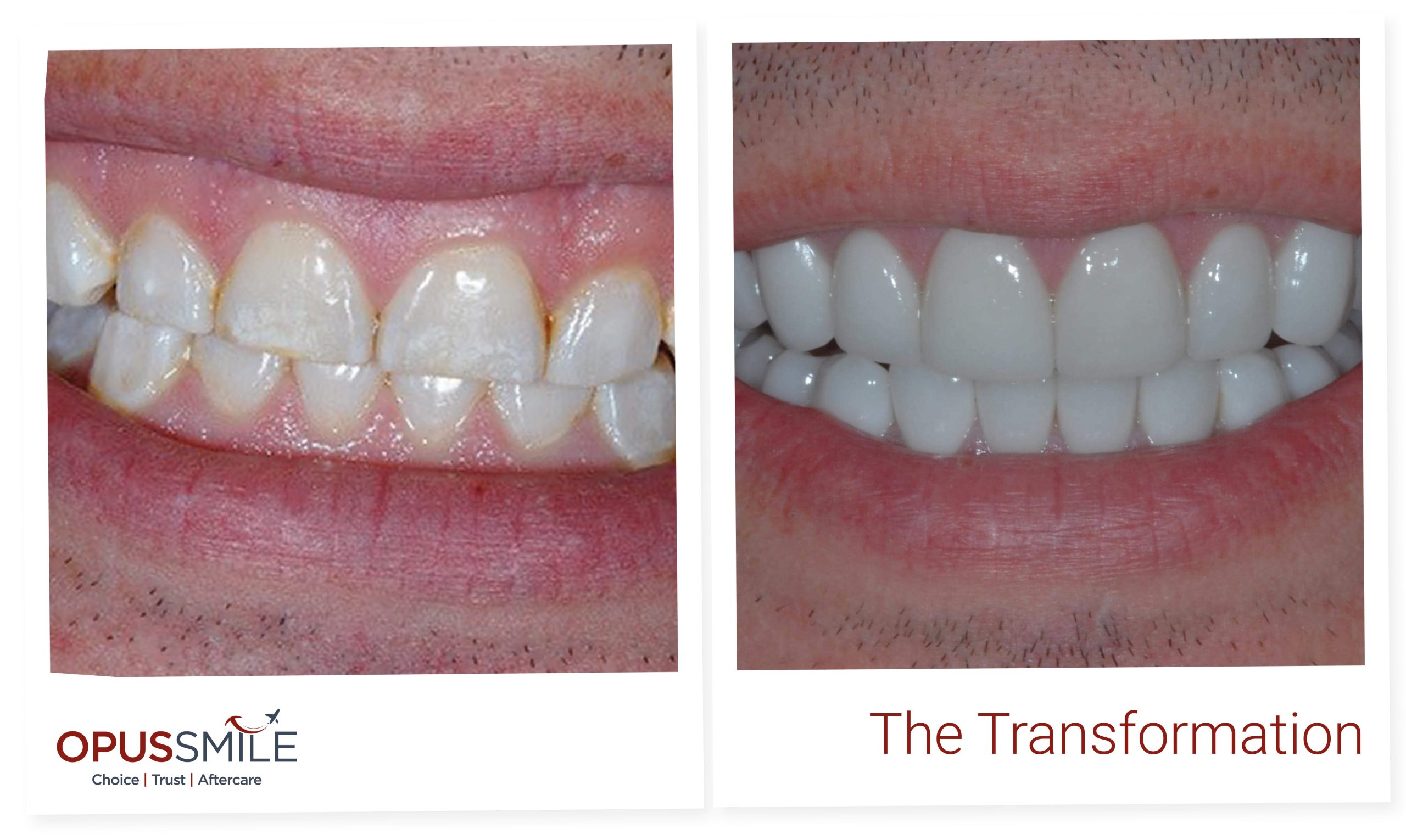 Smile Makeover 4