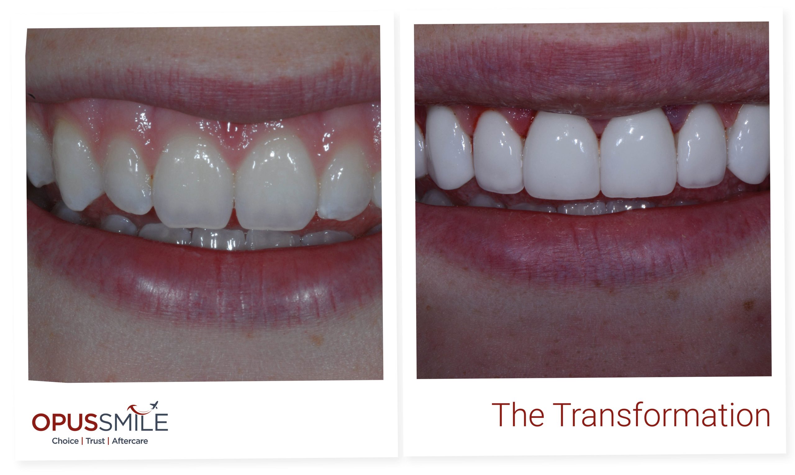 Veneers 1
