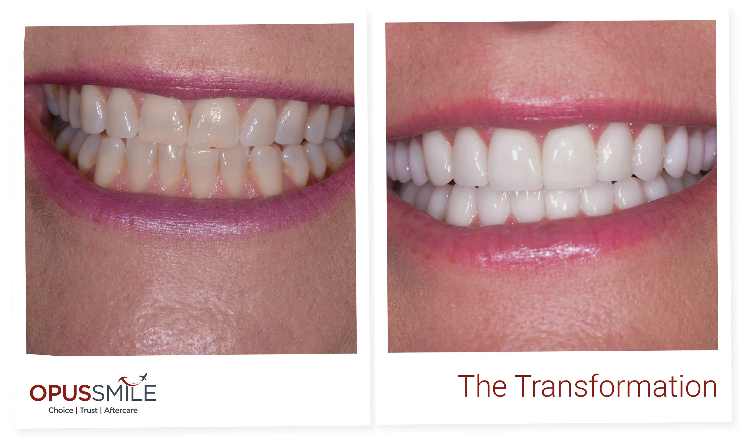 Veneers 3