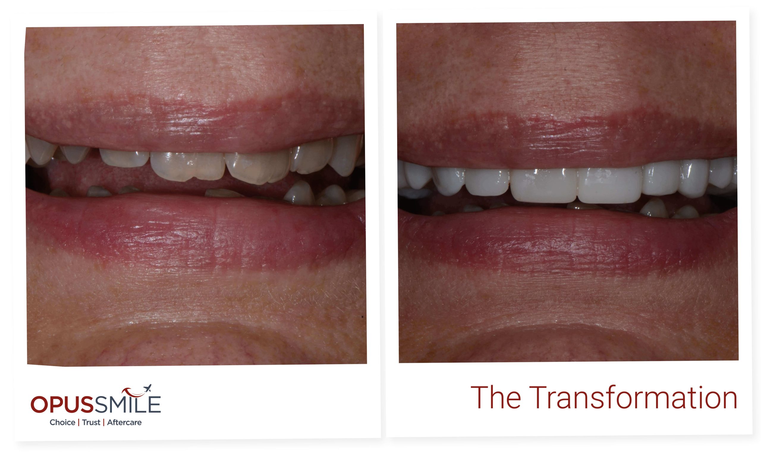 Veneers 4