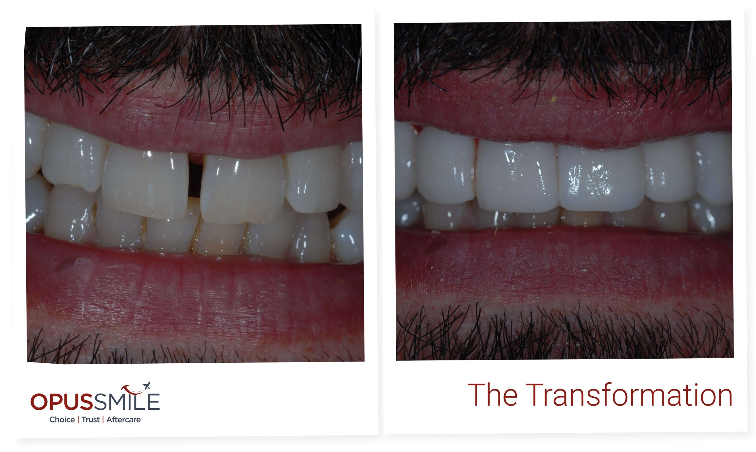 Veneers 5