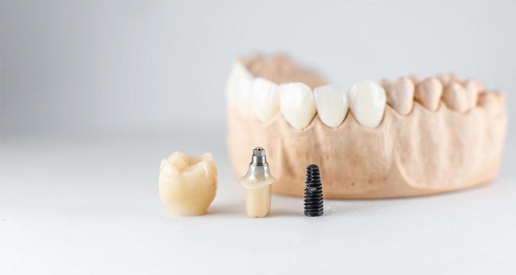 Implants