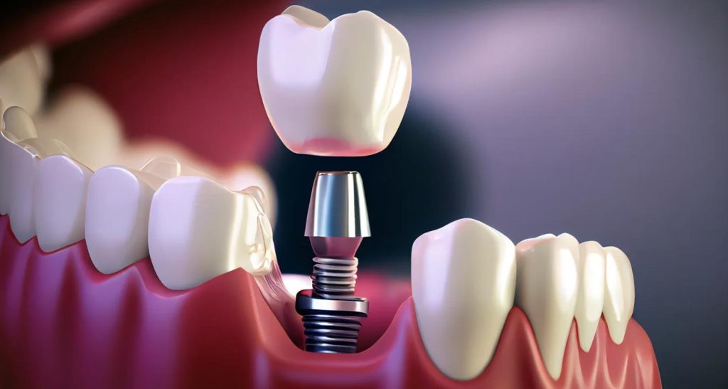 Are Dental Implants Safe in Turkey