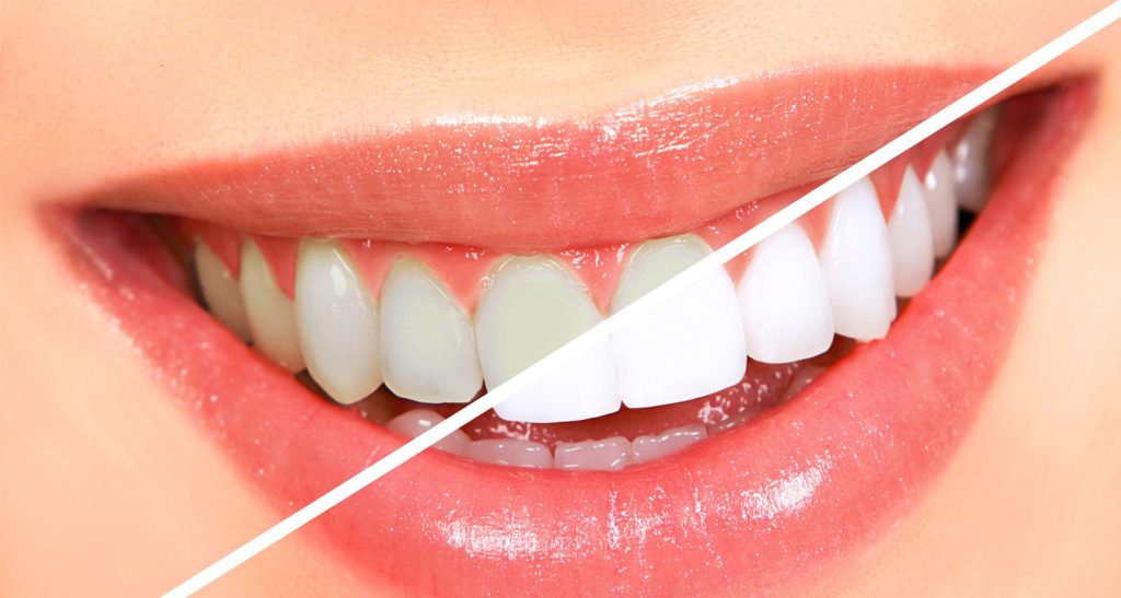Teeth whitening