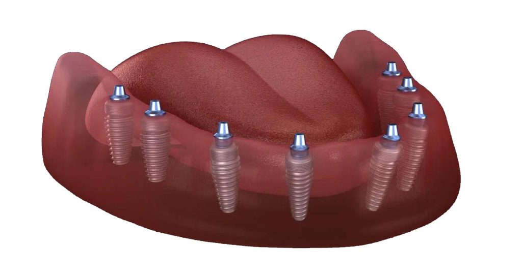 All on 8 dental implants